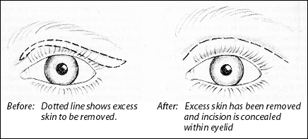Eyelid Surgery Diagram