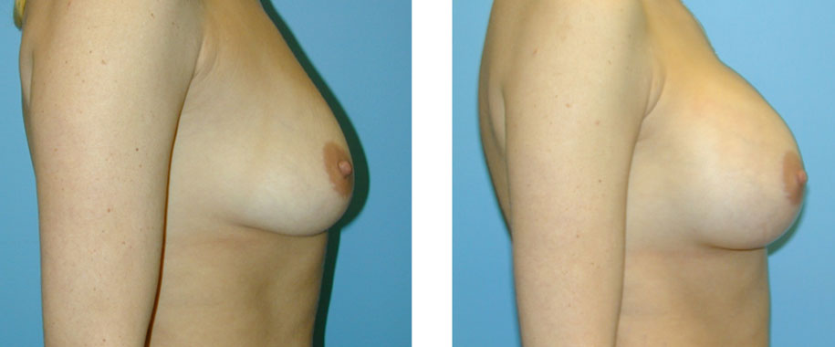 Breast Augmentation Results Chicago