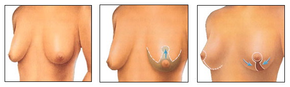 Breast Lift Diagram 2