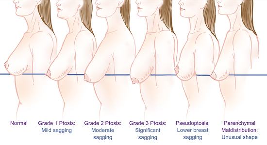 Breast Lift Diagram