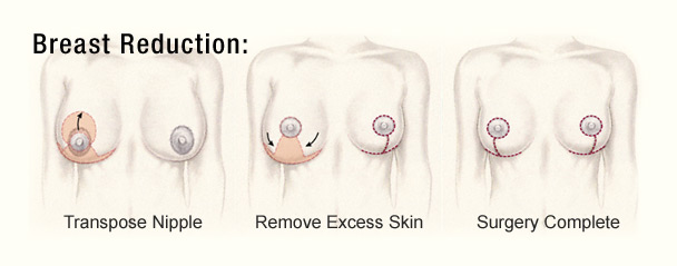Breast Reduction Diagram 2