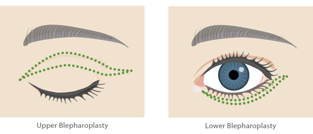 Eyelid Surgery Diagram 2