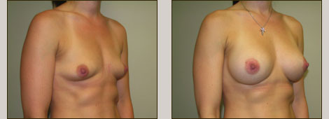 Breast Augmentation Patient 1 Left Side