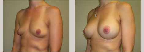 Breast Augmentation Patient 1 Right Side