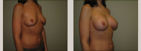 Breast Augmentation Patient 2 Left Side