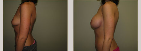 Breast Augmentation Patient 2 Right Side
