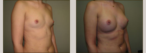 Breast Augmentation Patient 3 Left Side