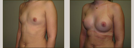 Breast Augmentation Patient 3 Right Side