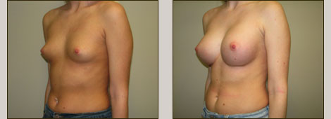 Breast Augmentation Patient 5