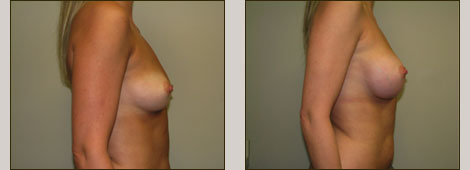 Breast Augmentation Patient 6