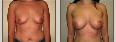 Breast Augmentation Patient 8