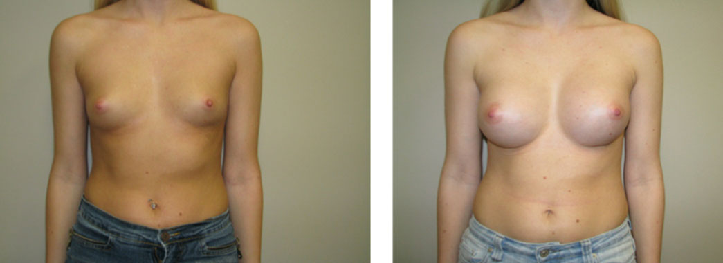 Breast Augmentation Results Chicago