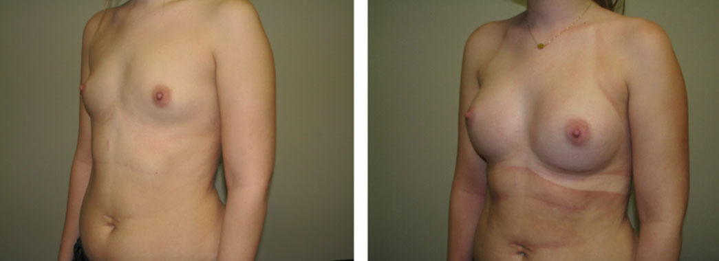 Breast Augmentation Results Chicagot