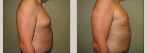 Male Breast Reduction Patient 1