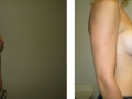Breast Augmentation Results Chicagot
