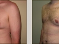 Male Breast Reduction Patient 2
