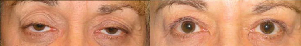 Eyelid Surgery before and after photo by Michael J. Lee M.D. in Chicago, IL