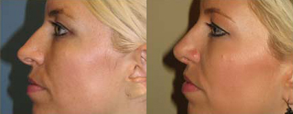 Rhinoplasty before and after photo by Michael J. Lee M.D. in Chicago, IL