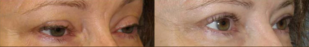 Eyelid Surgery before and after photo by Michael J. Lee M.D. in Chicago, IL