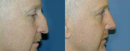 Rhinoplasty before and after photo by Michael J. Lee M.D. in Chicago, IL