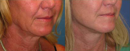 Facelift before and after photo by Michael J. Lee M.D. in Chicago, IL