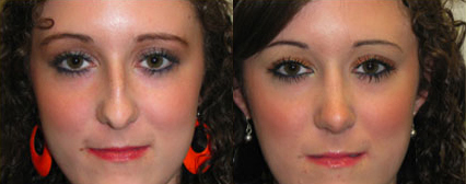 Rhinoplasty before and after photo by Michael J. Lee M.D. in Chicago, IL