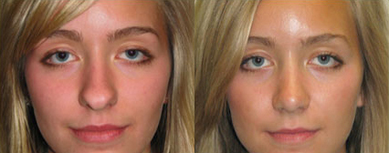 Rhinoplasty before and after photo by Michael J. Lee M.D. in Chicago, IL