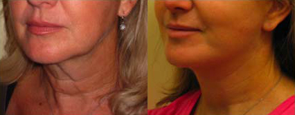 Facelift before and after photo by Michael J. Lee M.D. in Chicago, IL