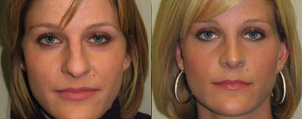 Rhinoplasty before and after photo by Michael J. Lee M.D. in Chicago, IL