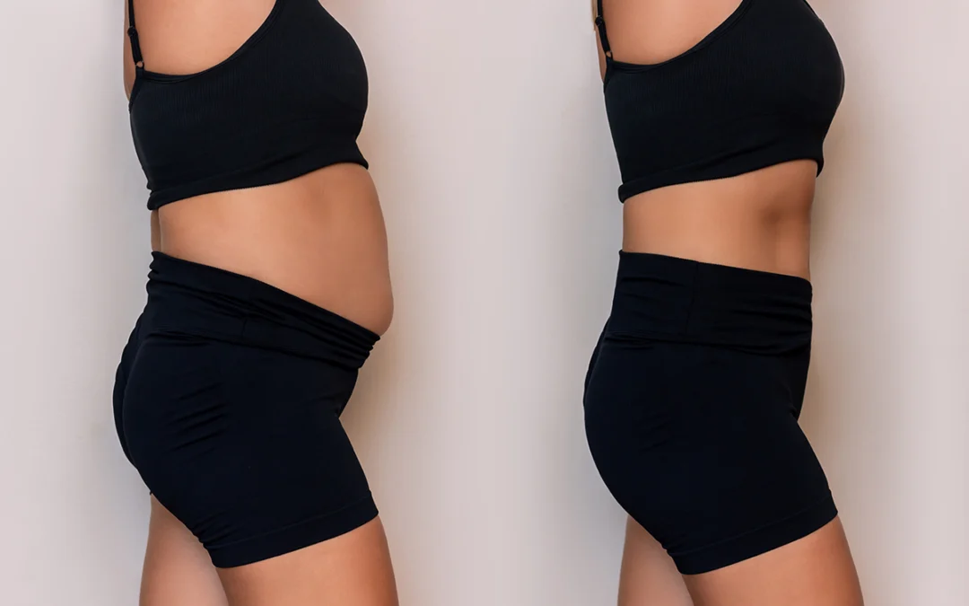 The Popular Body Contouring Procedure: Abdominoplasty