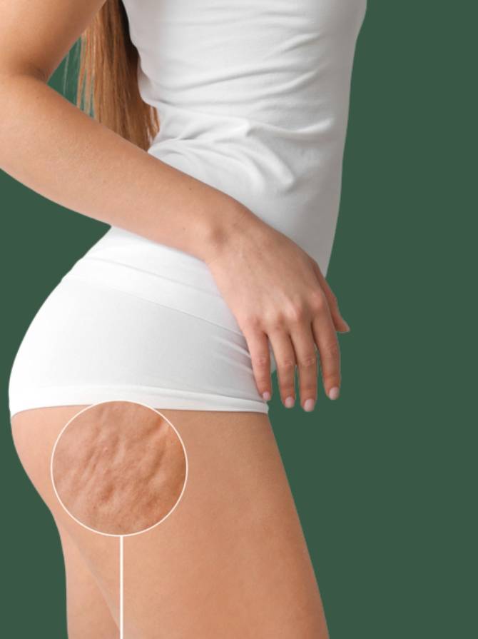 young woman in white outfit with cellulite